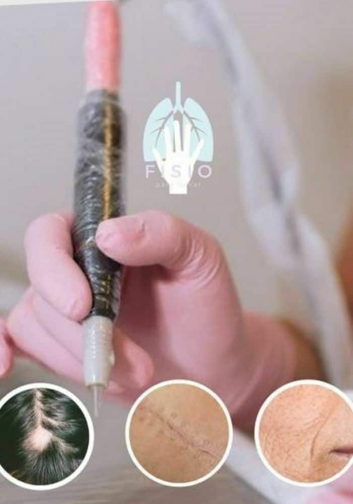 MICROPUNTURA BRASILEÑA