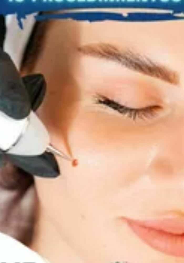 Entrenamiento En Electrolifting + Fibroblast Con Plasma