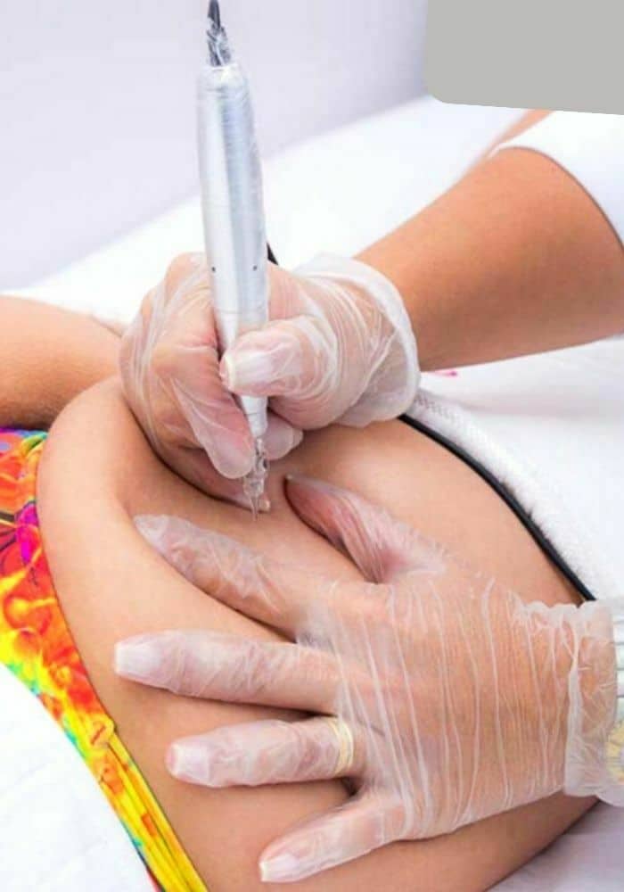 REPARACIÓN DE ESTRÍAS YESS LACROIX